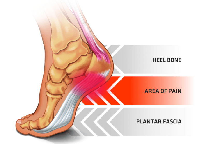 Plantar Fasciitis Tend A Foot Orthotics